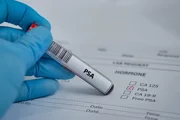 Рак простаты: массовый PSA-скрининг очень мало помогает для снижения смертности